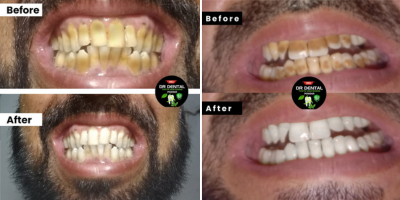 Teeth Whitening Success